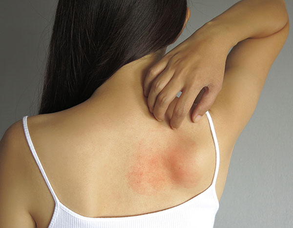 Skin & Allergy Care -treatment