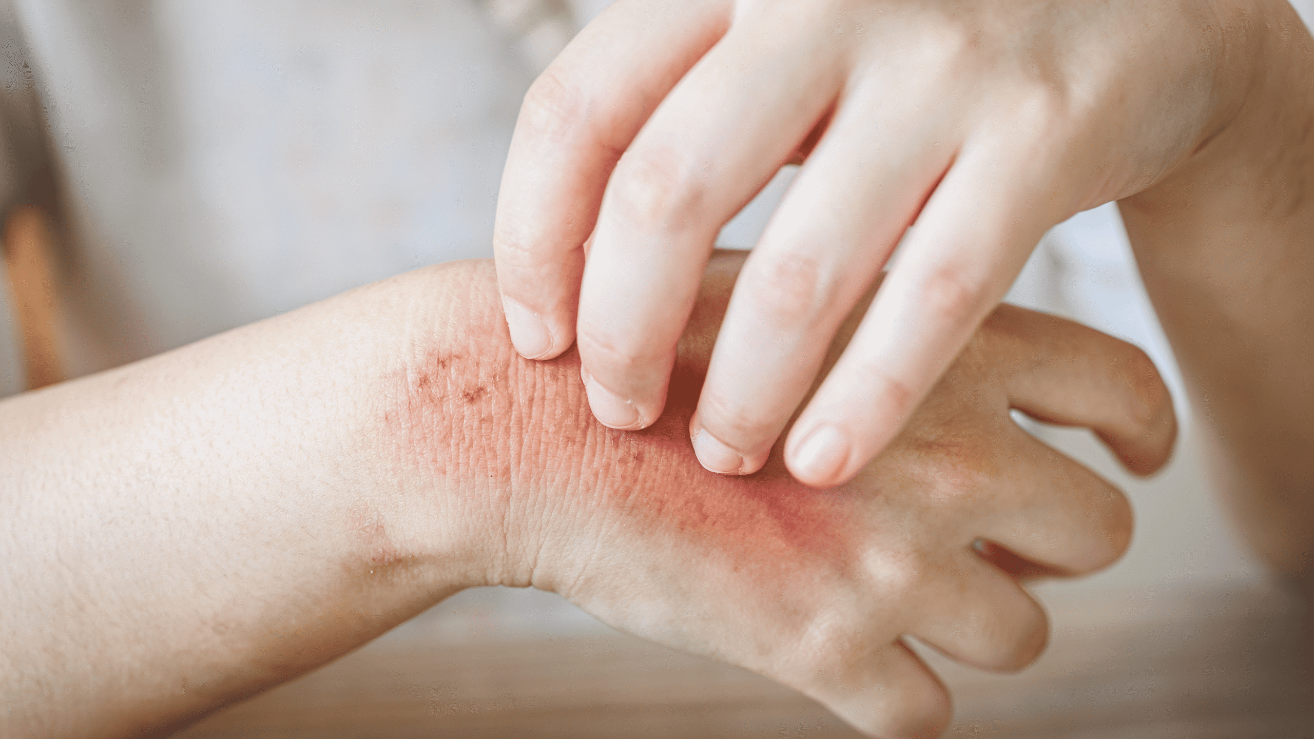 Skin & Allergy Care -treatment1